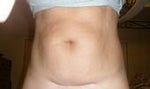before tummy tuck front view